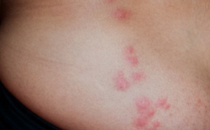 Pictures of Bed Bug Bites
